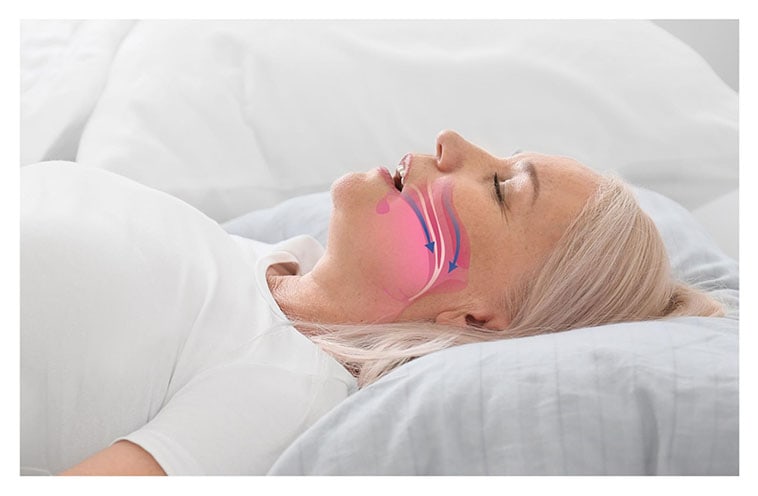 A woman sleeping on her back with a drawing of her obstructed airway superimposed over her mouth and throat.